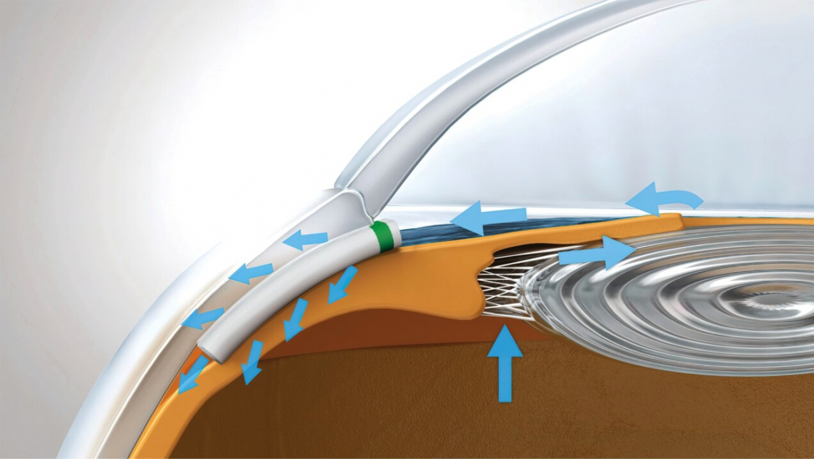 Ein Mikro-Stent leitet überschüssiges Augenwasser ab und senkt so den Augeninnendruck. istar Medical