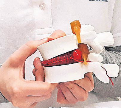 Eine angehende Physiotherapeutin zeigt ein Bandscheibenmodell, an dem sich ein Bandscheibenvorfall demonstrieren lässt. FOTO: LINDEN