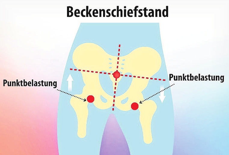 So sieht ein Beckenschiefstand aus.