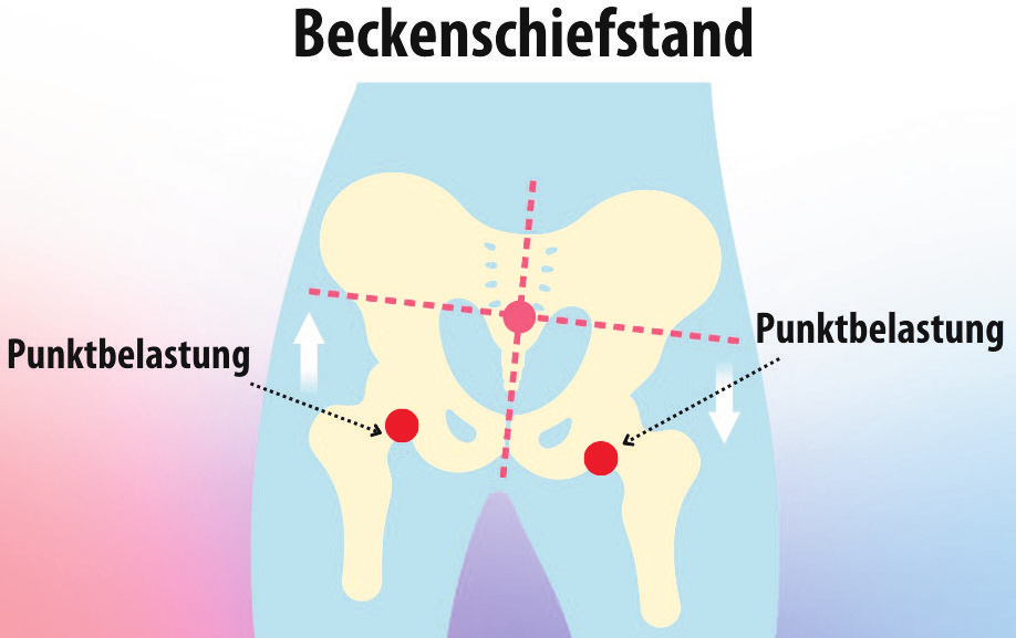 So sieht ein Beckenschiefstand aus. Foto: privat