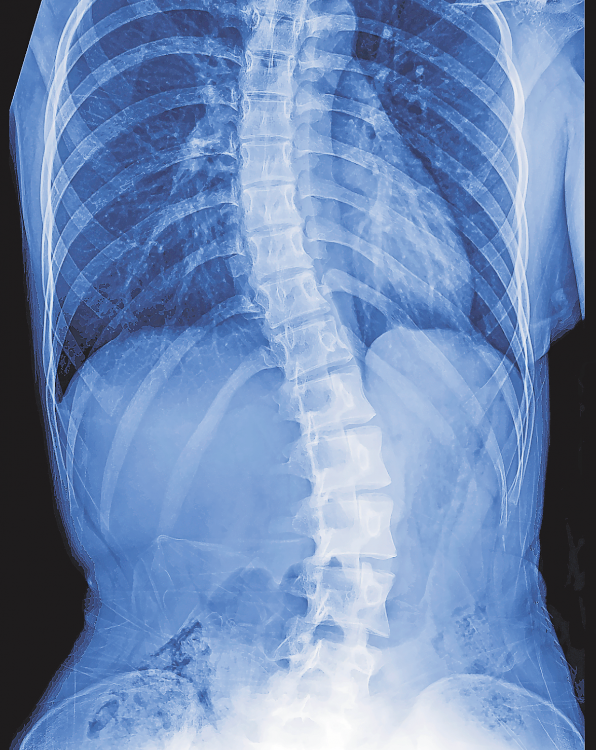 Welche Therapie infrage kommt, hängt wesentlich vom Grad der Verkrümmung ab.