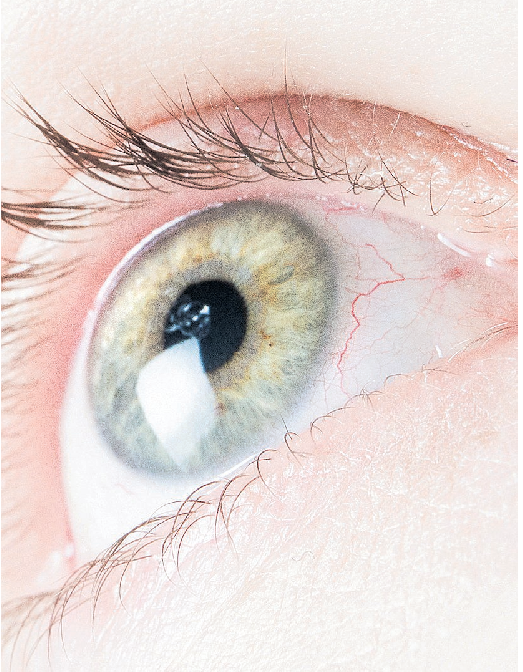 Das Auge ist von feinen Blutgefäßen durchzogen. Dass da mal eines platzt und für ein blutrotes Auge sorgt, lässt sich kaum vermeiden. FOTO: GABBERT/DPA