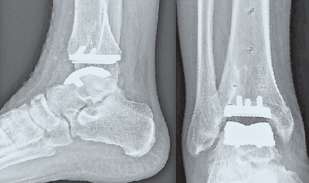 Röntgenbild eines mit einem Kunstgelenk ersetzten oberen Sprunggelenkes in der seitlichen Ansicht (links) und von vorne.RKU