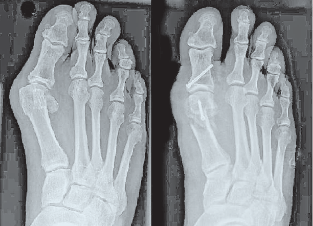 Röntgenbild vor (links) und nach einer Hallux valgus-Operation.