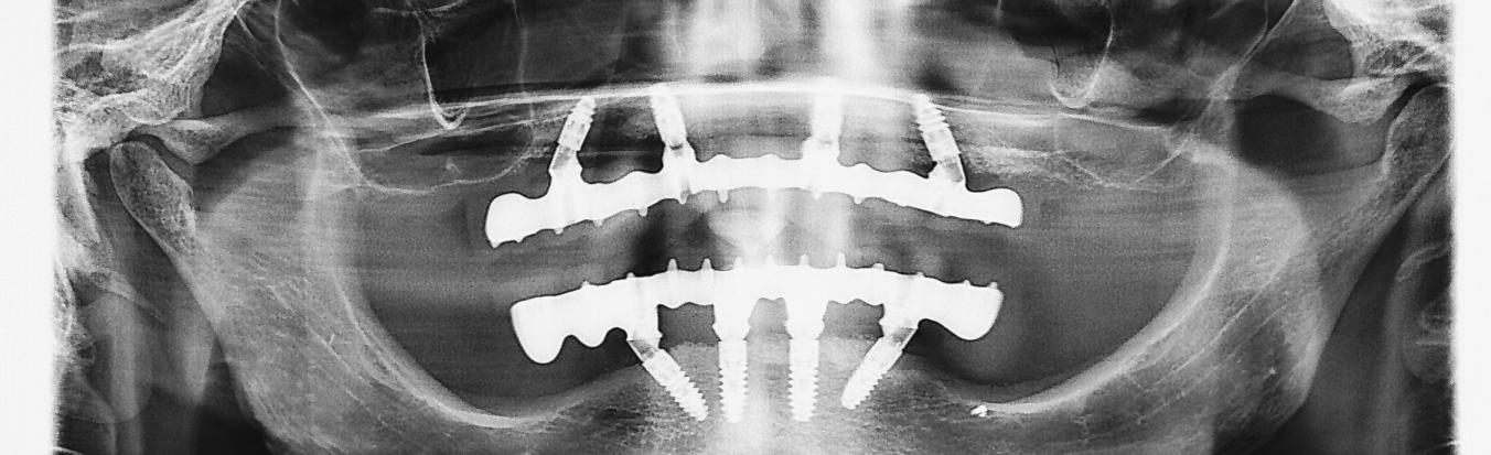Röntgenbild derselben Patientin zur Kontrolle 5 Jahre nach Implantat-Versorgung mit jeweils 4 Implantaten im Ober- und Unterkiefer (Sofort-Implantation & Sofort-Belastung)