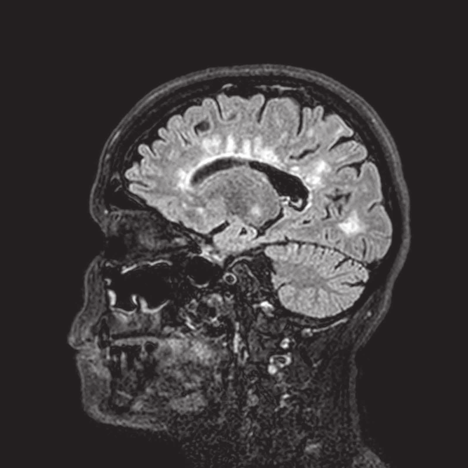 An einem solchen Bild des Instituts für Neuroradiologie erkennen Spezialisten das Krankheitsbild einer Multiplen Sklerose. Fotos: UKSH, freshidea-stock.adobe.com