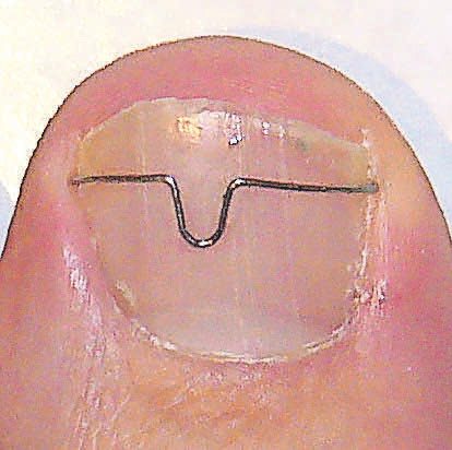 Eine Nagelkorrekturspange verhindert das Einwachsen des Nagels.
