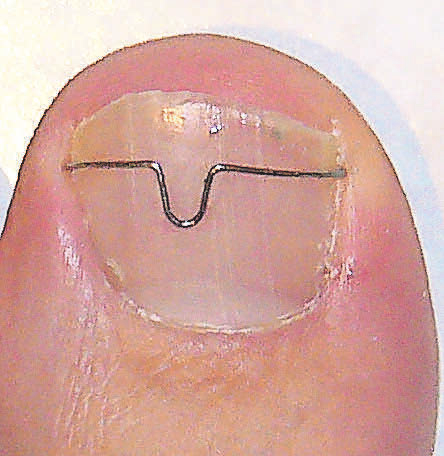 Eine Nagelkorrekturspange verhindert das Einwachsen des Nagels.