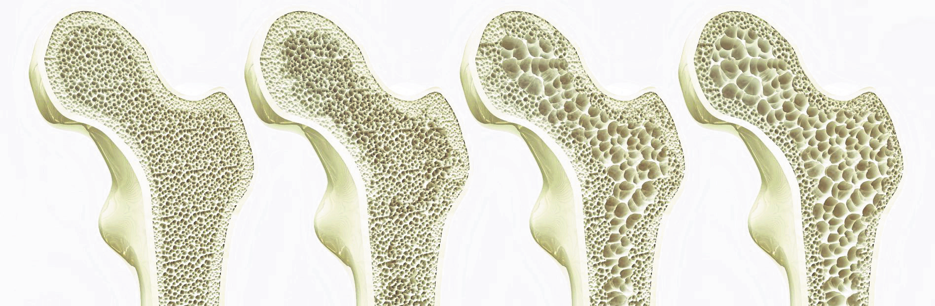Gesunde Knochensubstanz: Die Abnahme der Knochendichte bei Osteoporose lässt sich durch eine ausreichende Calciumversorgung verlangsamen. Foto: Shutterstock